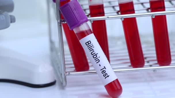 Bilirubina Test Cercare Anomalie Dal Sangue Campione Sangue Analizzare Laboratorio — Video Stock