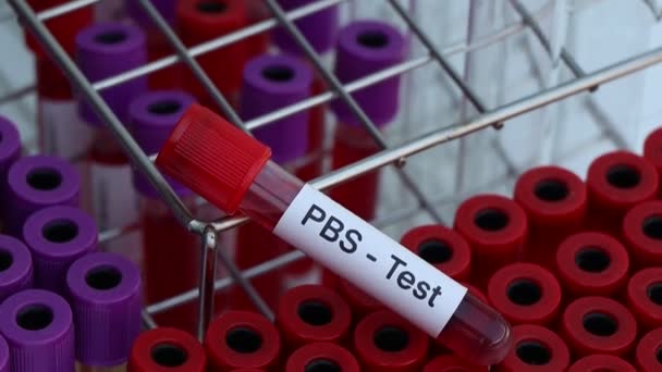 Pbs Перевіряє Немає Аномалій Крові Зразків Крові Аналізу Лабораторії Крові — стокове відео