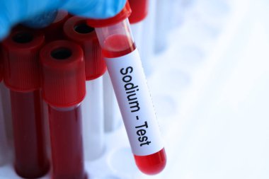 Kandaki anormallikleri araştırmak için sodyum testi laboratuvarda analiz edilecek kan örneği, test tüpünde kan.