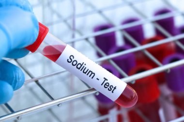 Kandaki anormallikleri araştırmak için sodyum testi laboratuvarda analiz edilecek kan örneği, test tüpünde kan.