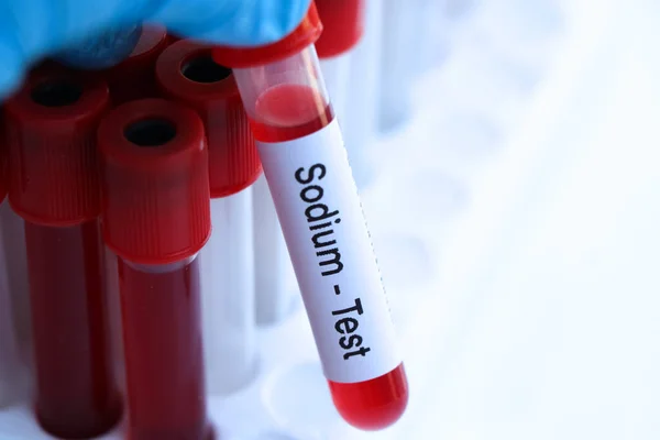 Sodium test to look for abnormalities from blood,  blood sample to analyze in the laboratory, blood in test tube