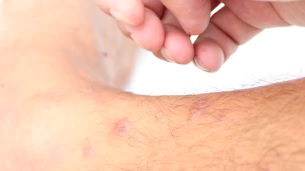 Wound Skin Caused Scratch Allergic Skin Mosquito Insect Bites — Vídeos de Stock