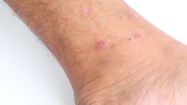 Wound Skin Caused Scratch Allergic Skin Mosquito Insect Bites — Stock Video