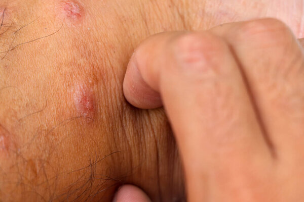 рана на коже, вызванная аллергической кожей царапин от укусов комаров или насекомых