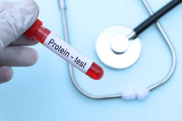 protein test to look for abnormalities from blood,  blood sample to analyze in the laboratory, blood in test tube