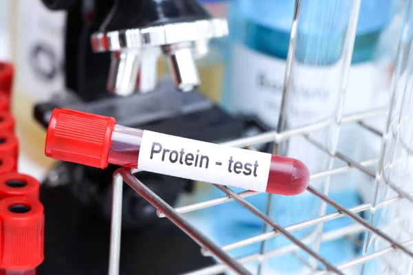 protein test to look for abnormalities from blood,  blood sample to analyze in the laboratory, blood in test tube