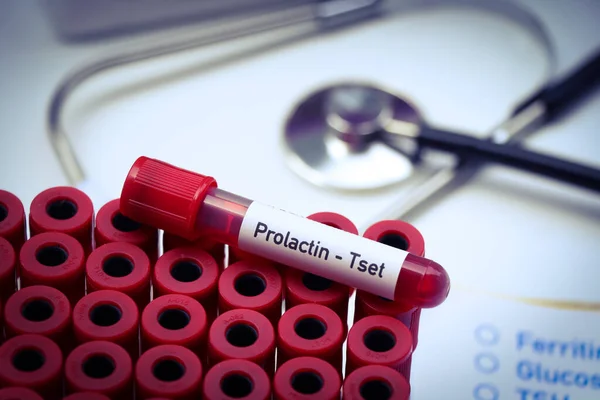 Prueba Prolactina Para Buscar Anormalidades Sangre Muestra Sangre Para Analizar — Foto de Stock