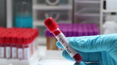 Cinsel yolla bulaşan hastalıklar için kan testleri laboratuvarda analiz edilecek kan örnekleri, test tüpünde kan örnekleri.