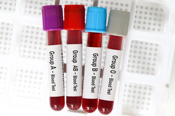 stock image Group blood test, blood sample to analyze in the laboratory, blood in test tube