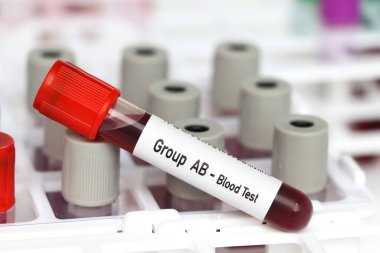 Grup AB - Kan Testi, laboratuvarda analiz edilecek kan örneği, test tüpünde kan