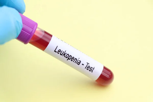Prueba Leucopenia Muestra Sangre Para Analizar Laboratorio Sangre Tubo Ensayo — Foto de Stock