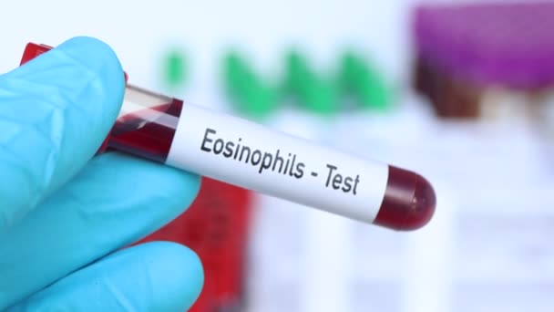 Teste Eosinófilos Amostra Sangue Para Analisar Laboratório Sangue Tubo Teste — Vídeo de Stock