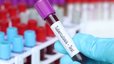 Tüberküloz testi, laboratuvarda analiz edilecek kan örneği, test tüpünde kan.