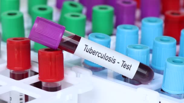 Teste Tuberculose Amostra Sangue Para Analisar Laboratório Sangue Tubo Teste — Vídeo de Stock
