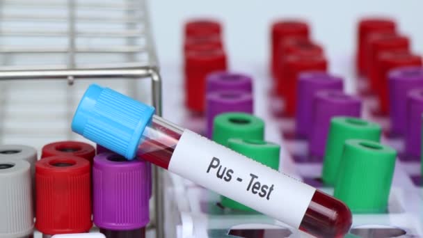 Teste Pus Amostra Sangue Para Analisar Laboratório Sangue Tubo Teste — Vídeo de Stock