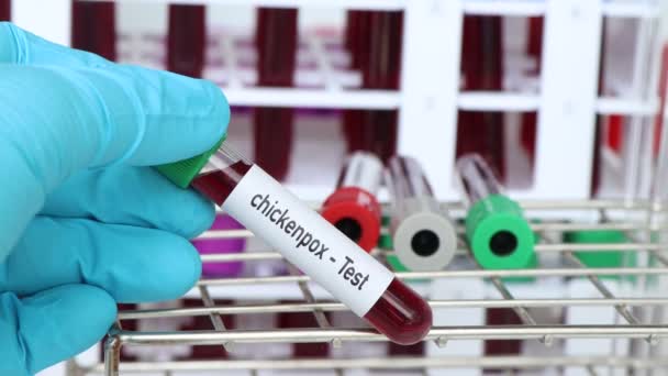 Waterpokken Test Bloedmonster Analyseren Het Laboratorium Bloed Reageerbuis — Stockvideo