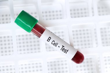 B hücre testi, laboratuvarda analiz edilecek kan örneği, test tüpünde kan.