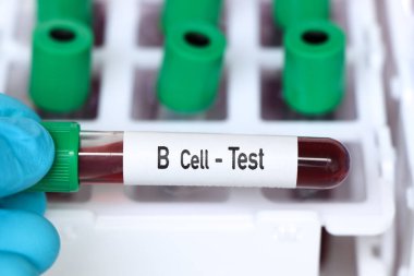 B hücre testi, laboratuvarda analiz edilecek kan örneği, test tüpünde kan.