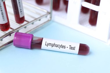 Lenfosit testi, laboratuvarda analiz edilecek kan örneği, test tüpünde kan.