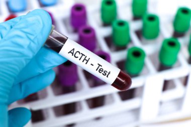 ACTH testi, laboratuvarda analiz edilecek kan örneği, test tüpünde kan.