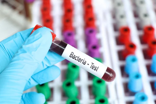 Prueba Bacterias Muestra Sangre Para Analizar Laboratorio Sangre Tubo Ensayo — Foto de Stock