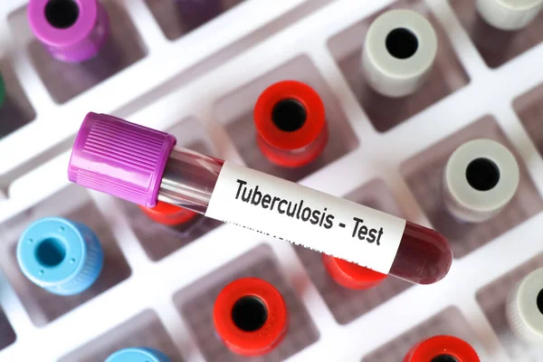 Prueba Tuberculosis Muestra Sangre Para Analizar Laboratorio Sangre Tubo Ensayo — Foto de Stock