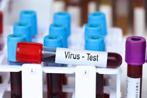 stock image Virus test, blood sample to analyze in the laboratory, blood in test tube