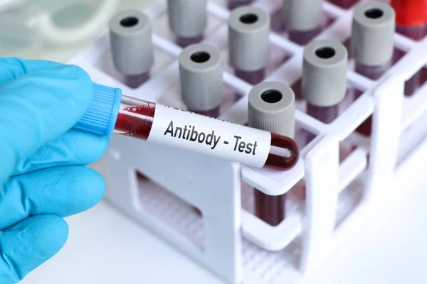 Prueba Anticuerpos Muestra Sangre Para Analizar Laboratorio Sangre Tubo Ensayo — Foto de Stock