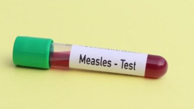 Kızamık testi, laboratuvarda analiz edilecek kan örneği, test tüpünde kan.