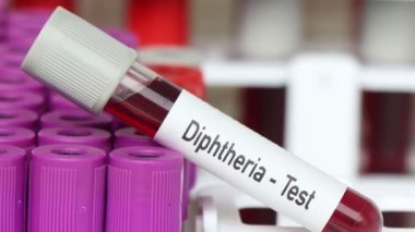 Difteri testi, laboratuvarda analiz edilecek kan örneği, test tüpünde kan.