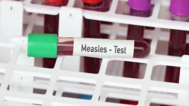 Kızamık testi, laboratuvarda analiz edilecek kan örneği, test tüpünde kan.