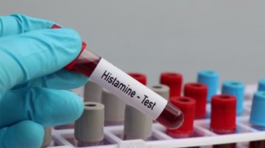 Histamin testi, laboratuvarda analiz edilecek kan örneği, test tüpünde kan.