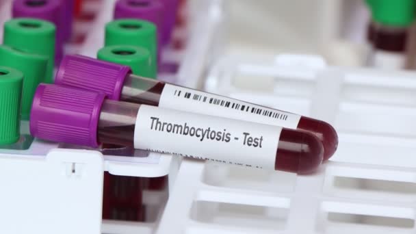 Trombositoz Testi Laboratuvarda Analiz Edilecek Kan Örneği Test Tüpünde Kan — Stok video