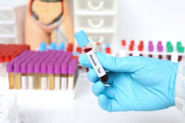 Monosit testi, laboratuvarda analiz edilecek kan örneği, test tüpünde kan.