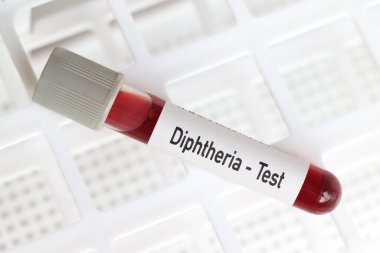 Difteri testi, laboratuvarda analiz edilecek kan örneği, test tüpünde kan.