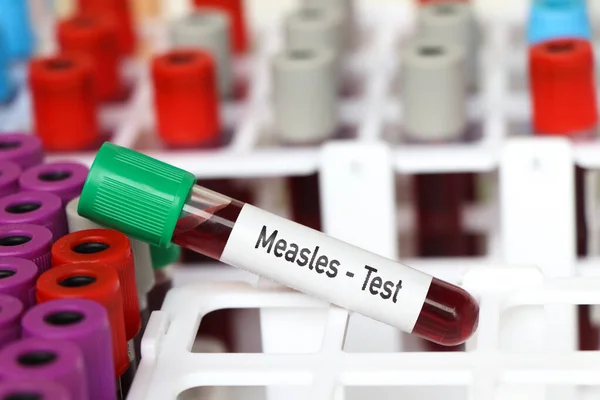 Kızamık Testi Laboratuvarda Analiz Edilecek Kan Örneği Test Tüpünde Kan — Stok fotoğraf