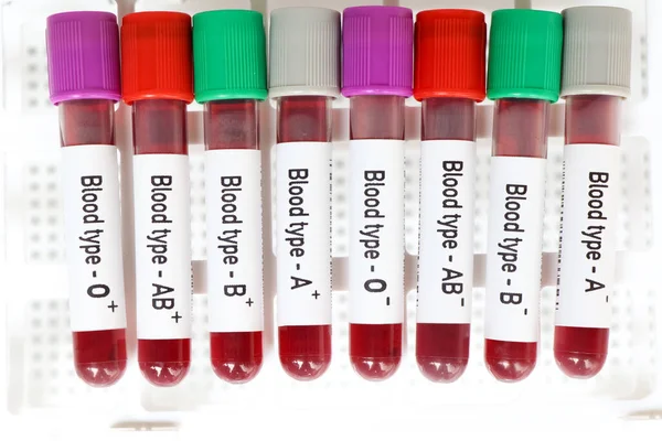 Blood type Rh positive and negative test, blood sample to analyze in the laboratory, blood in test tube