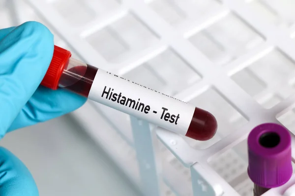 Prueba Histamina Muestra Sangre Para Analizar Laboratorio Sangre Tubo Ensayo — Foto de Stock