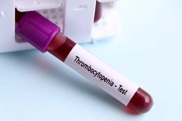 Prueba Trombocitosis Muestra Sangre Para Analizar Laboratorio Sangre Tubo Ensayo — Foto de Stock