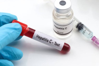 Kan ve bilimsel deneylerdeki anormallikleri bulmak için Hepatit C testi