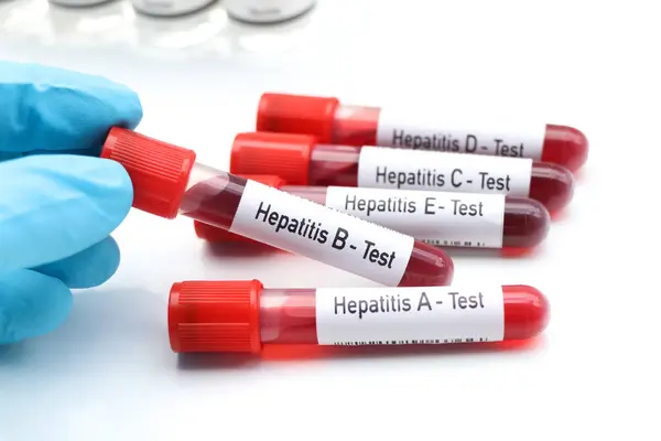 Hepatitis Test Auf Auffälligkeiten Blut Wissenschaftliches Experiment Stockfoto