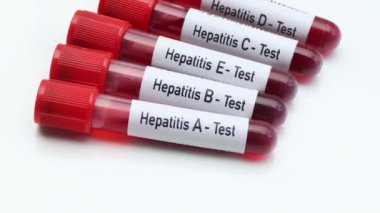 Kan ve bilimsel deneylerdeki anormallikleri bulmak için Hepatit testi