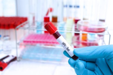 Kan ve bilimsel deneydeki anormallikleri bulmak için HPV testi