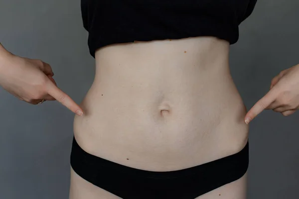 Naked woman in black underwear point by fingers at stretch marks on flat belly, gray background. Scars on body after pregnancy, weight loss, childbirth. Imperfections of figure, body positive.