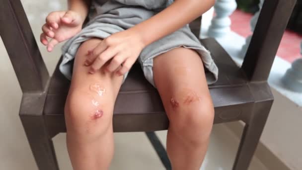 Boy Broken Knees Sits Chair Summer Day Afraid Smear Wounds — Stock Video