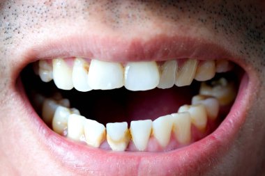 Diş kötü sigara içen bir adam. Sigara içen bir adamın diş çürüğü ve diş kalkülüsü vardır, bu yüzden hijyene dikkat etmeliyiz.