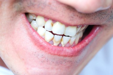 Diş kötü sigara içen bir adam. Sigara içen bir adamın diş çürüğü ve diş kalkülüsü vardır, bu yüzden hijyene dikkat etmeliyiz.