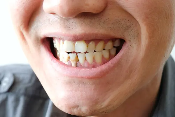 Tooth Man Smoking Bad Man Smokes Cigarettes Have Tooth Decay — Stock Photo, Image