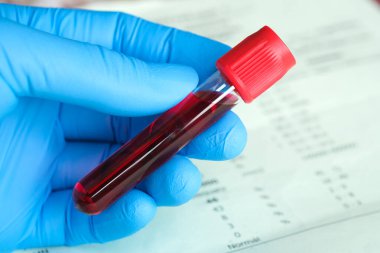 Kan örnekleri ve kan testi sonuçları. Sağlık ve tıbbi kavramlar