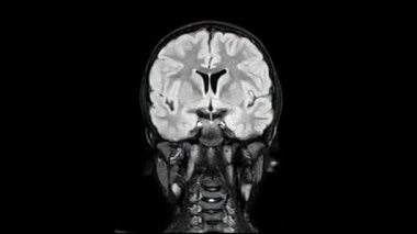 Sağlıklı 10 yaşındaki bir çocuğun MRI beyin taraması. Önden arkaya, döngü.